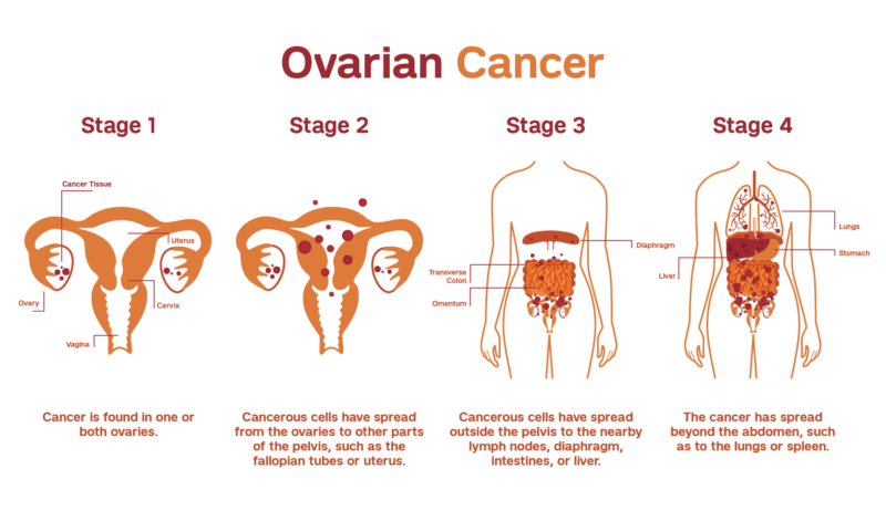 Stages of Ovarian Cancer