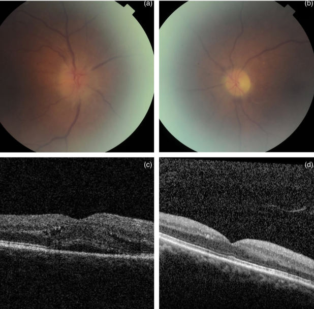 Chemotherapy and ocular side effects 