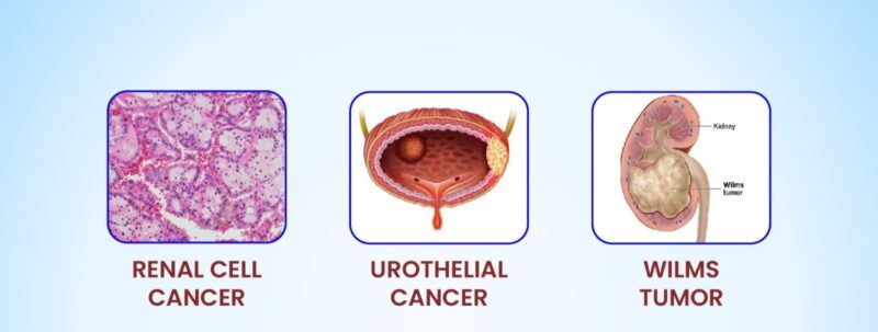 Understanding Kidney Cancer: Causes, Symptoms, and Prevention - Medicaid Cancer Foundation