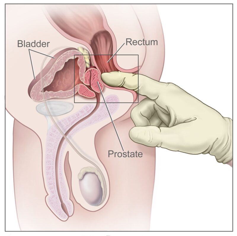 rectal examination