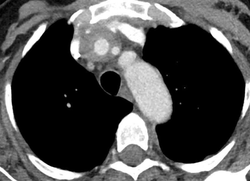 Pembrolizumab-induced vasculitis in a 70 year old woman with endometrial cancer