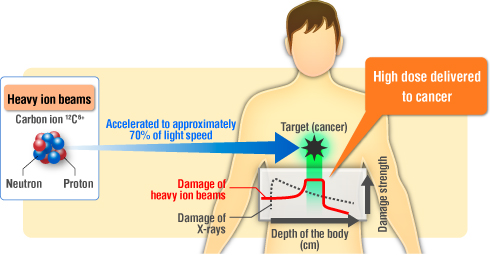 Heavy Ion Therapy