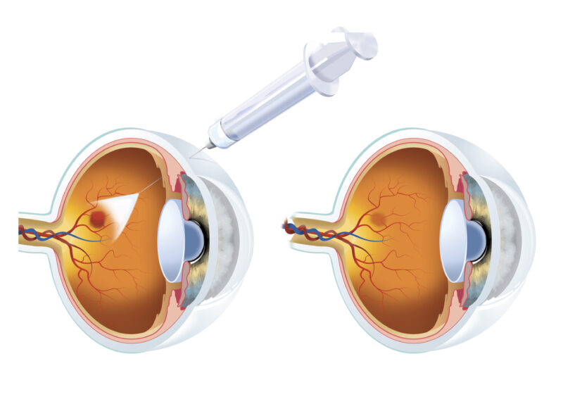 Ocular Side Effects of Anti-VEGF Therapy