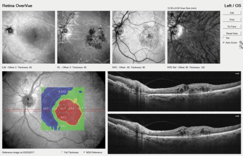 Ocular Side Effects of Anti-VEGF Therapy