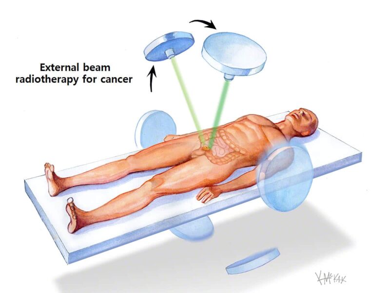 radiotherapy for rectal cancer