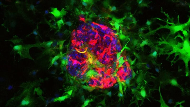 National Institute for Health and Care Excellence has recommended capivasertib for advanced breast cancer NHS patients