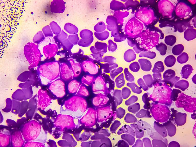 How immune cell baselines may predict CD22 therapy outcomes in Pediatric Cancer - NCI Center for Cancer Research