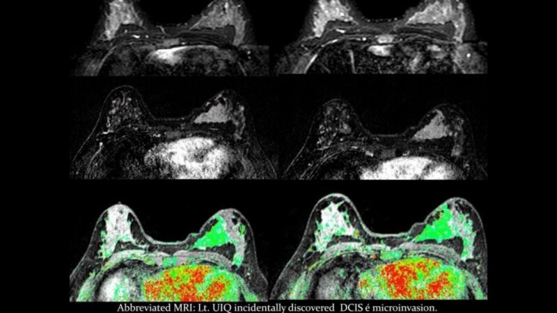 Sahar Mansour: Insights on Abbreviated MRI for Breast Cancer Screening
