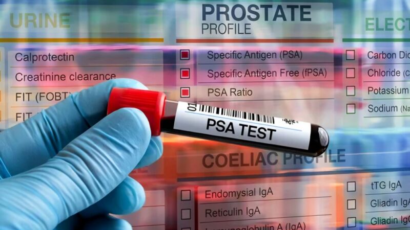 50 % of men will have a rising PSA after prostatectomy for Prostate Cancer  – ASCO