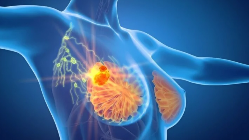 NEJM Reports Phase 3 Trial on Omitting Nodal Irradiation in Node-Positive Breast Cancer