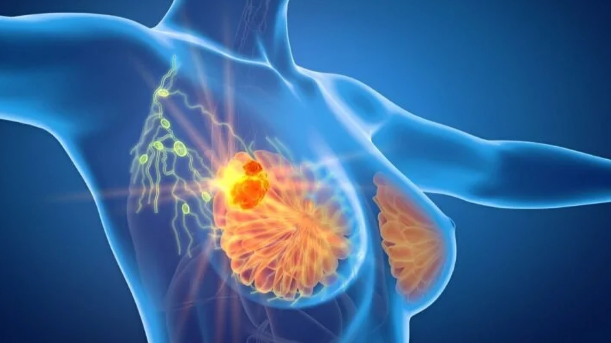 Mark Bolton: SKAGEN-1 – Breast Cancer Mortality by Treatment arm