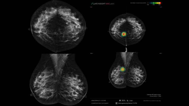 Sahar Mansour: First prospective study in Egypt to evaluate AI in double reading for breast cancer screening