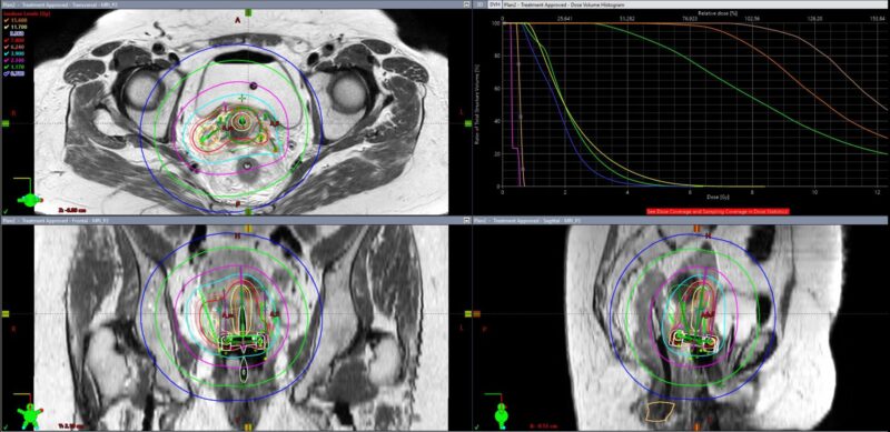 Hathal Haddad: A Major Step Forward in Cervical Cancer Treatment at Tübingen University Hospital