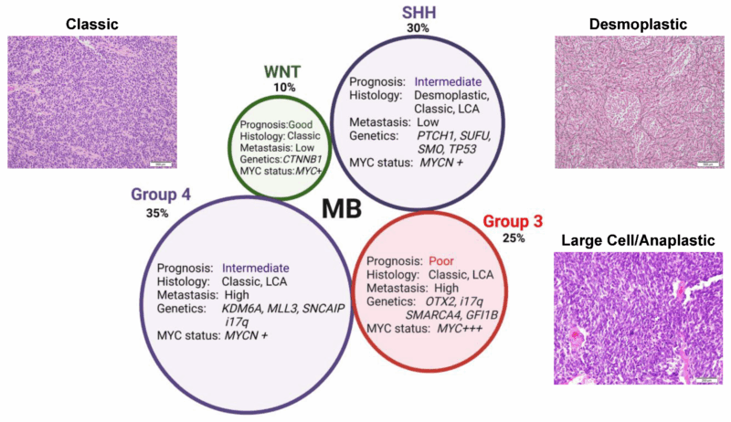 Medulloblastoma 