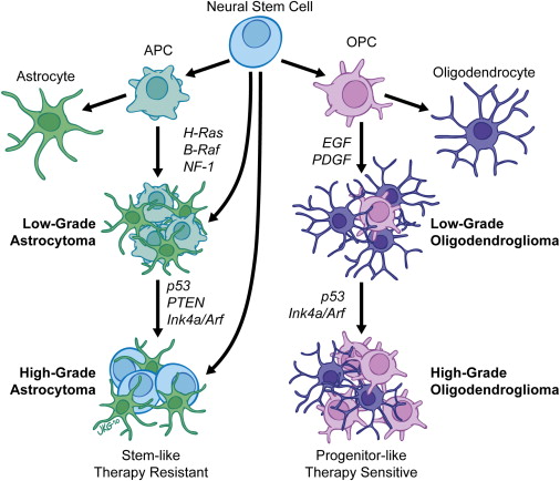 oligodendroglioma