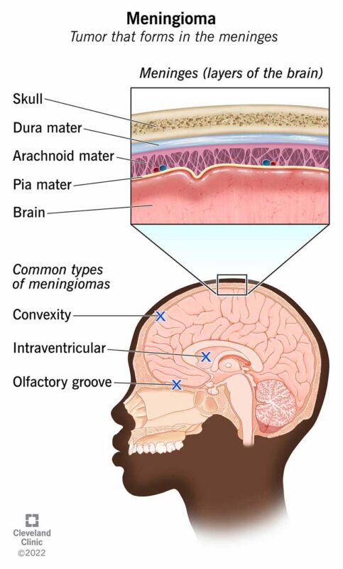 meningioma