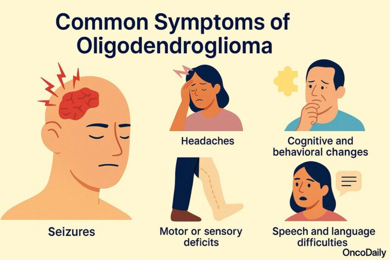 oligodendroglioma