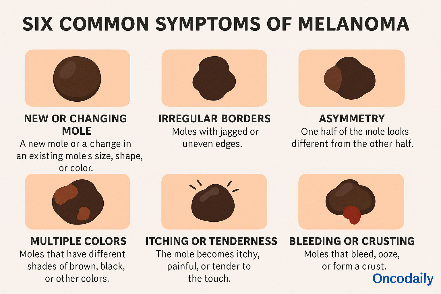 Bob Marley cancer melanoma , melanoma symptoms