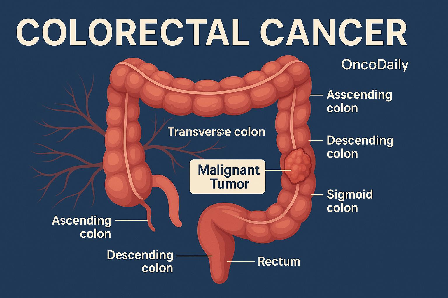 Colorectal Cancer: