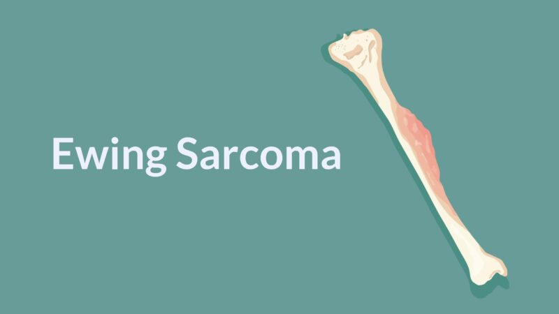 LOXHD1 Identified as Immunotherapy Target in Ewing Sarcoma – Parker Institute for Cancer Immunotherapy