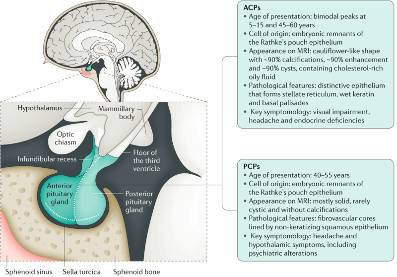 craniopharingioma 