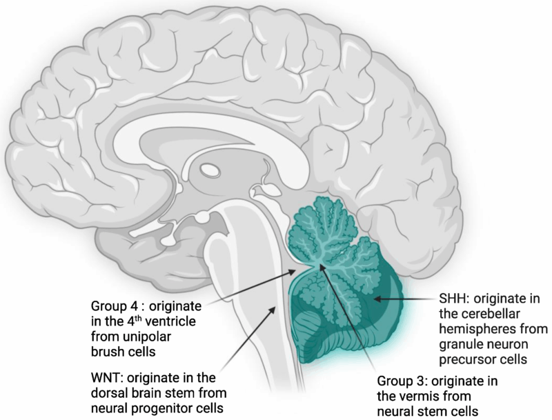 Medulloblastoma 
