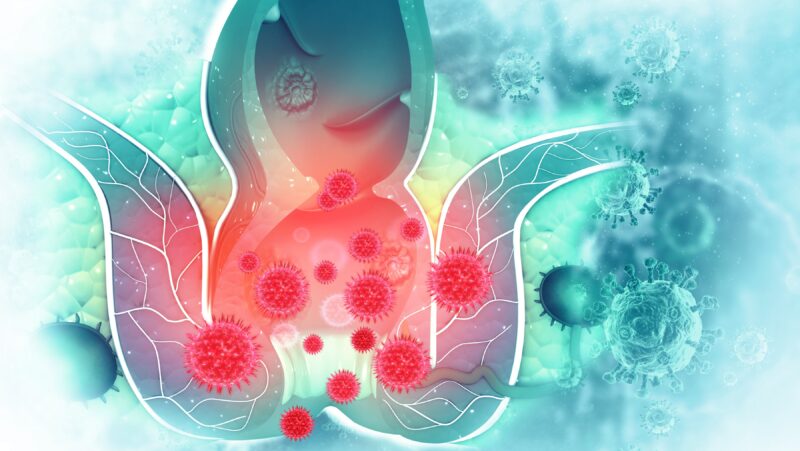 Duke Radiation Oncology – Guidance on Radiation Therapy a First for Anal Cancer Patients