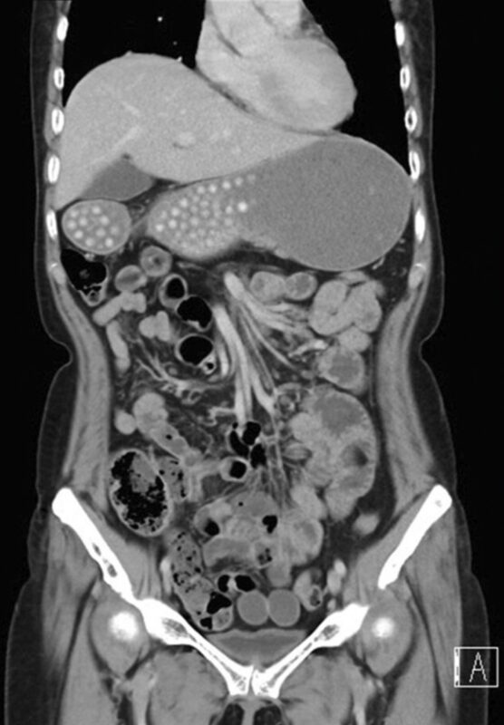 Mark Lewis: Fascinating discussion of bezoars at tumor board