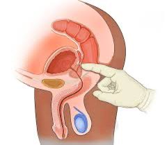 Prostate Cancer Facts by Joe Y Chang