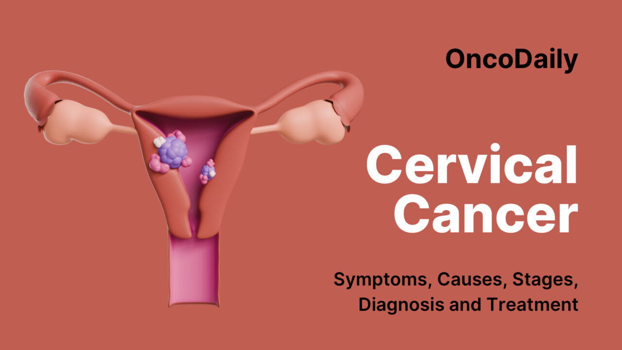 Cervical Cancer: Symptoms, Causes, Stages, Diagnosis and Treatment