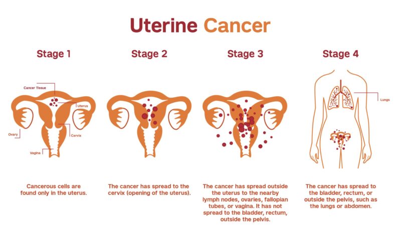 Uterine Cancer 
