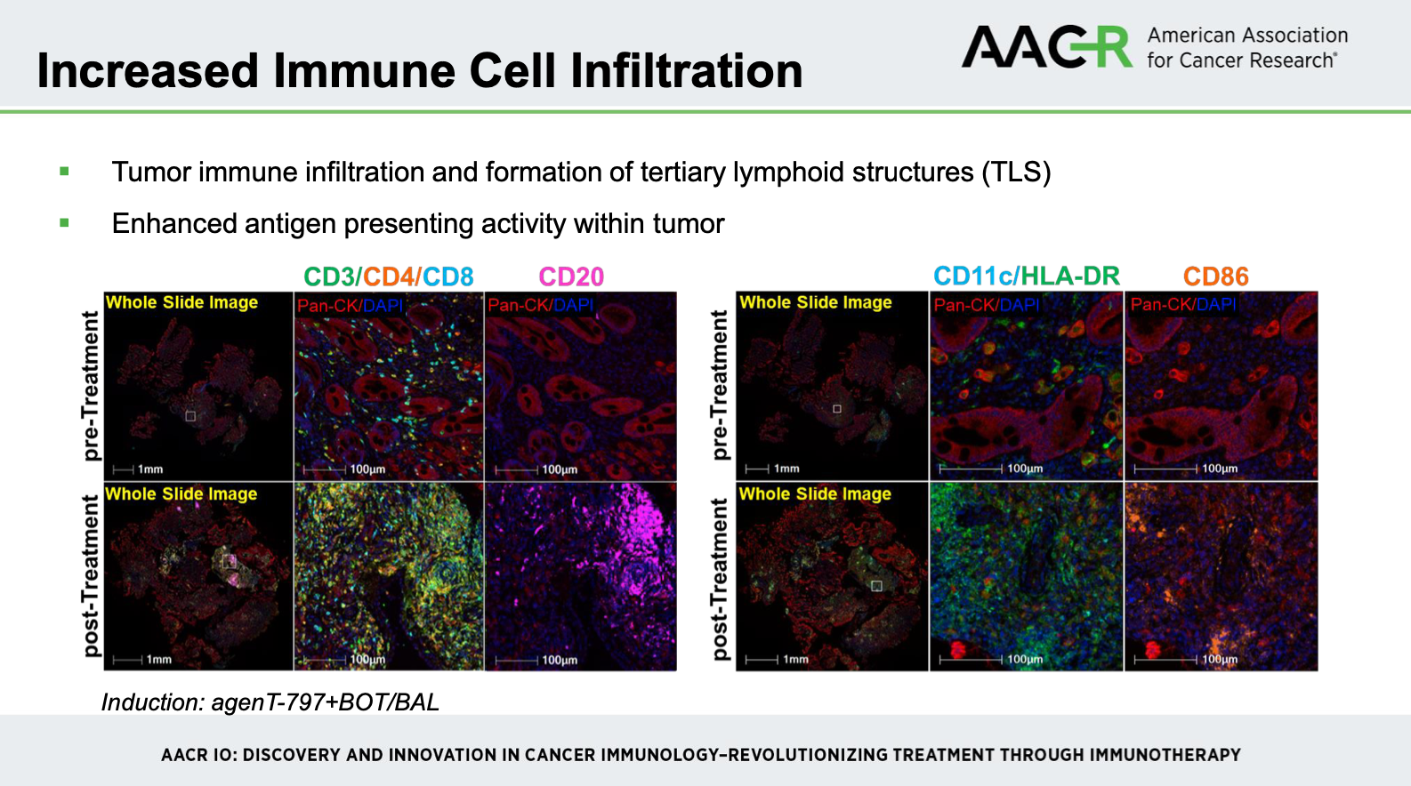 gastroesophageal cancer tils inkt cells aacr