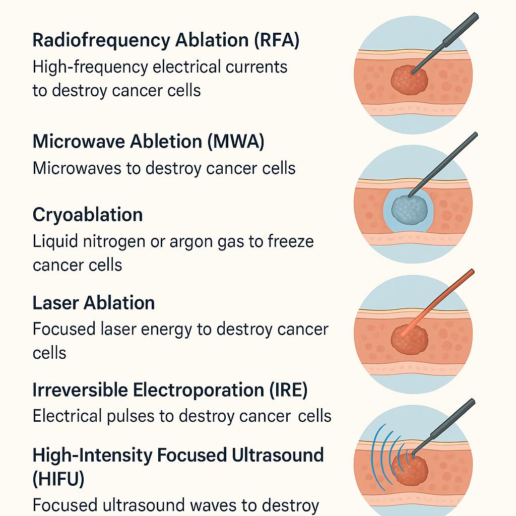Types of Ablation Therapy