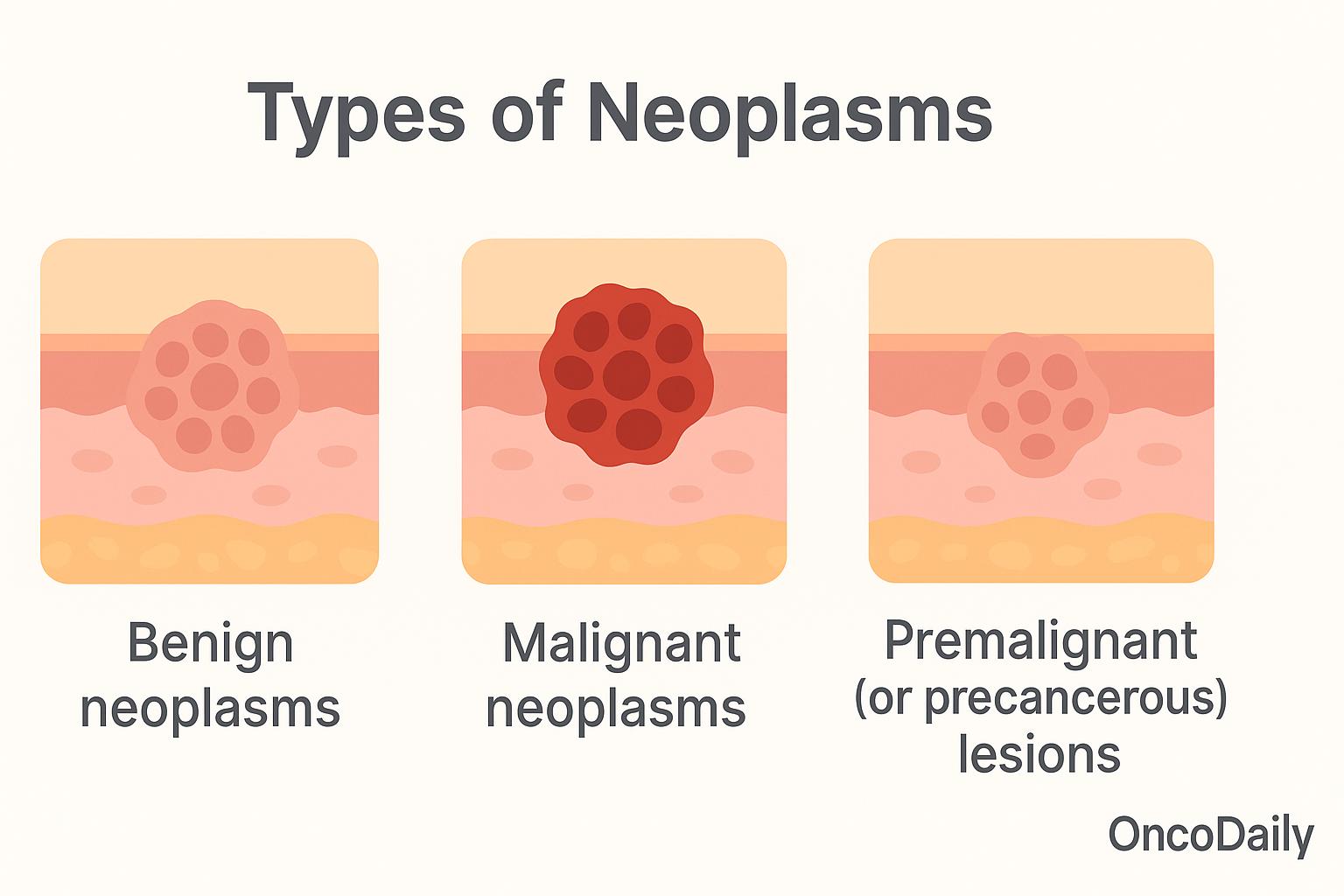 Types of Neoplasms