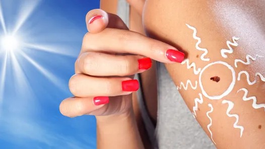 IARC paper estimates global burden of cutaneous melanoma caused by excess UV – IARC