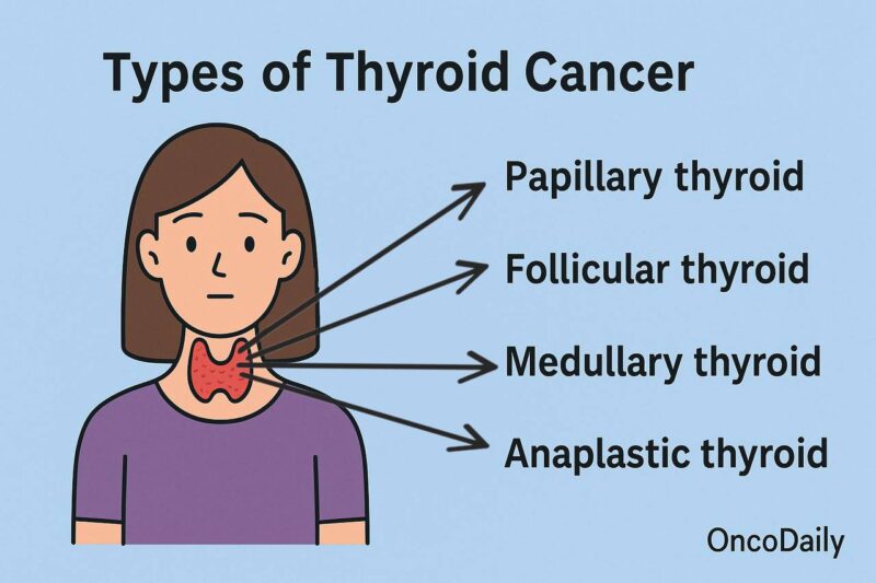 Types of Thyroid Cancer on Oncodaily