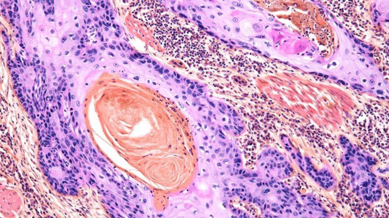 DNA Differences May Explain Why Some Melanoma Patients Don’t Respond to Immunotherapy – CRI