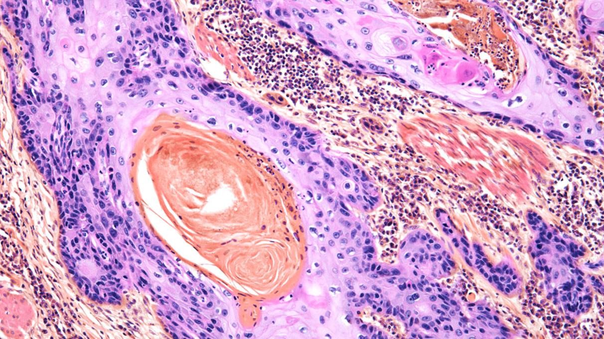 DNA Differences May Explain Why Some Melanoma Patients Don’t Respond to Immunotherapy – CRI