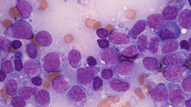 Thousands of Blood Cancer Patients Could Benefit From a New Drug Combination – The Institute of Cancer Research