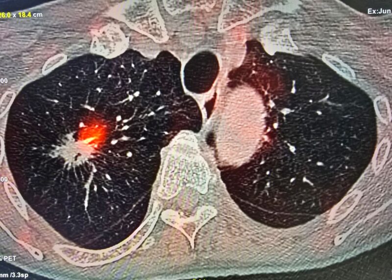 FAPI PET-CT