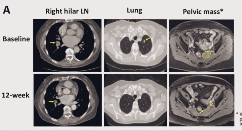 15 Posts Not to Miss from the 4th Day of ASCO 2025