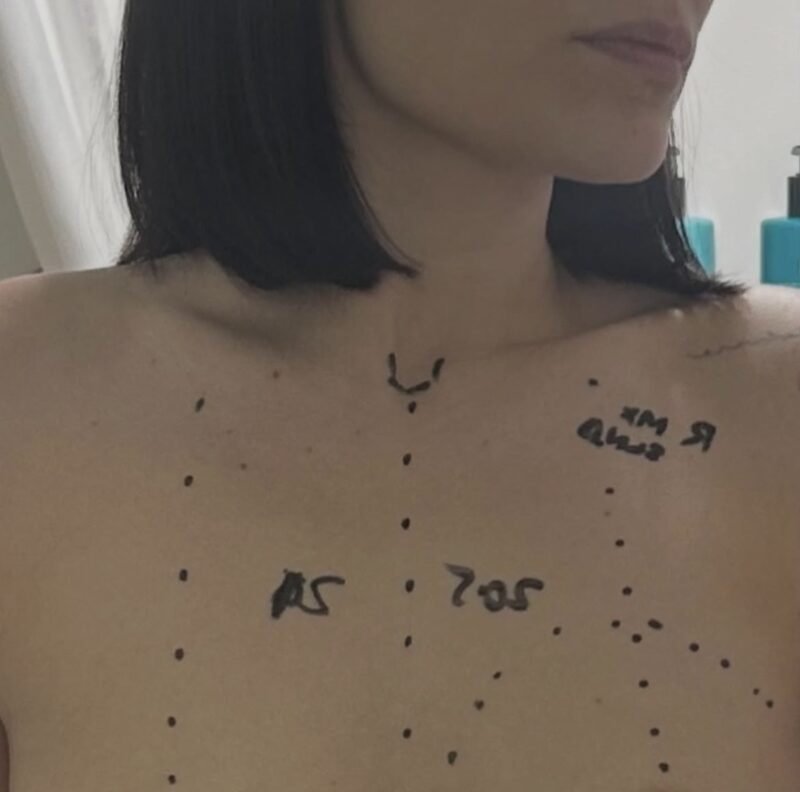 Jessie J Diagnosed with Early-Stage Breast Cancer: What Is the Prognosis?