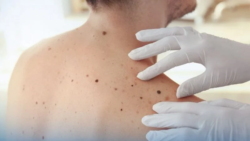 EORTC Shared Phase 2 EORTC-1612 EBIN Trial Results on First-Line Treatment Strategy in BRAF-Mutant Melanoma