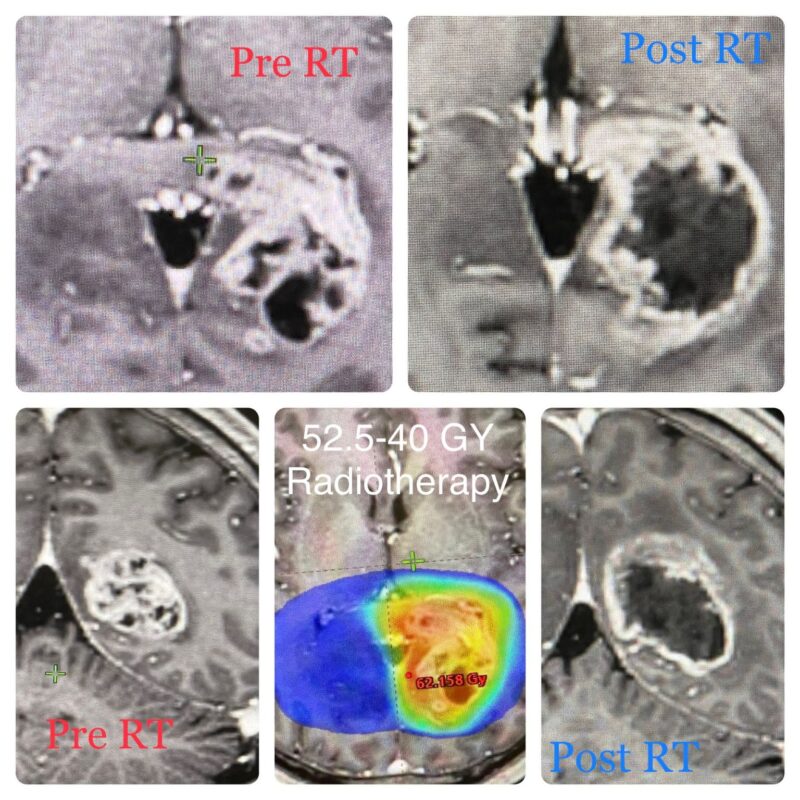 Glioblastoma Multiforme 