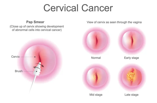 Cervical Cancer Screening Pap test pap smear