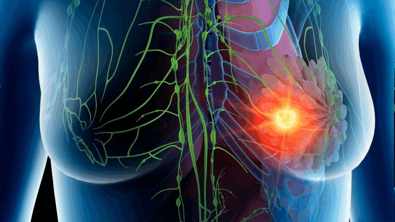 The First-Ever AI Tool that Predicts a Woman’s Breast Cancer Risk over the following 5 year – The Breast Cancer Research Foundation