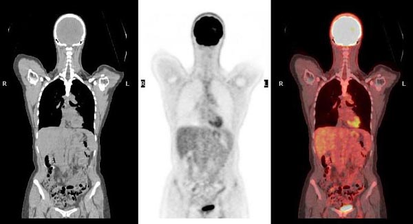 PET Scan