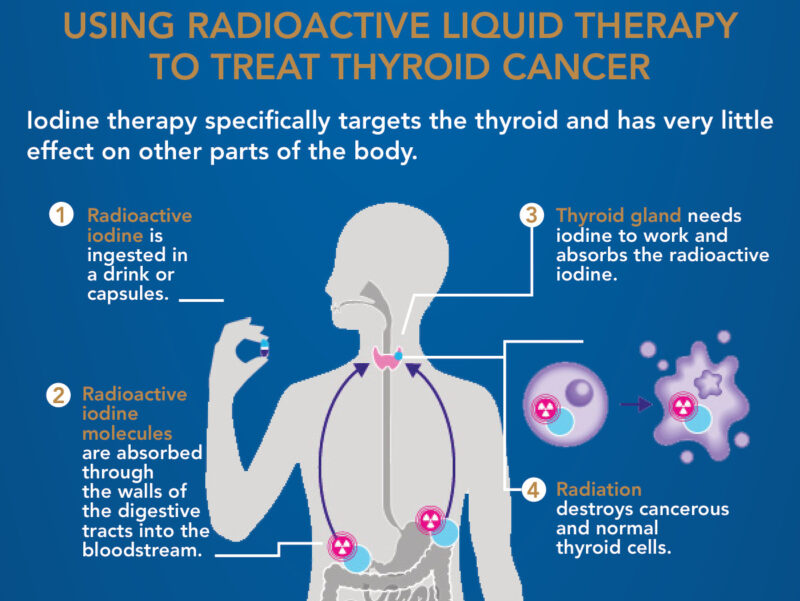 Radiotherapy For Thyroid Cancer: Types, Success Rate, Side Effects And More
