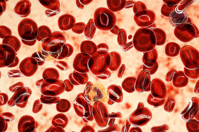 Polycythemia Vera