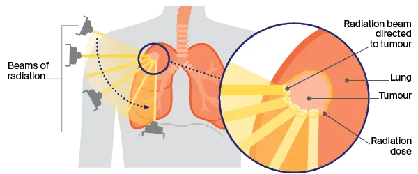 Early Stage Non-Small Lung Cancer